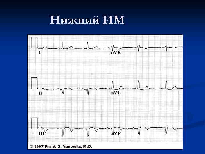 Нижний ИМ 