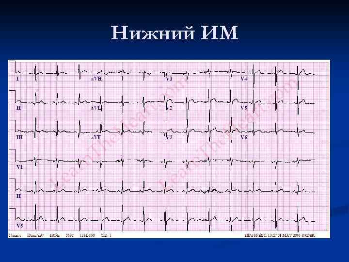 Экг инфаркт миокарда фото