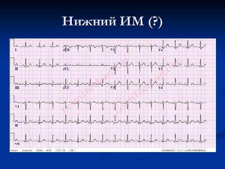 Нижний ИМ (? ) 