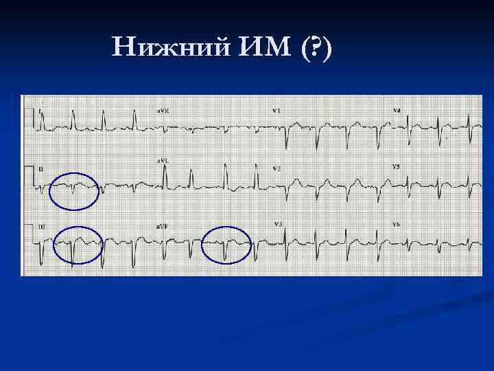 Нижний ИМ (? ) 