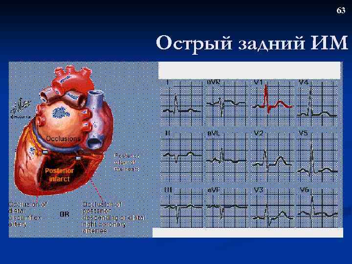 63 Острый задний ИМ 