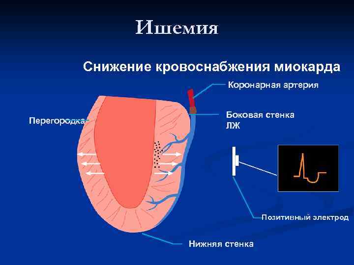 Нарушения в миокарде нижне боковой стенки