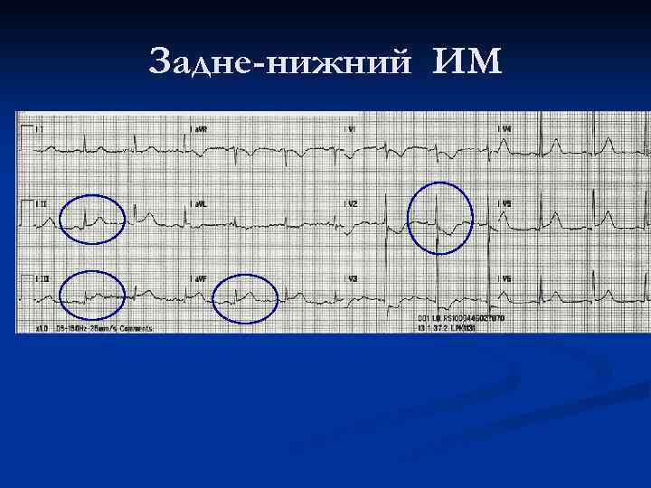 Задне-нижний ИМ 