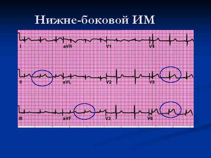 Нижне-боковой ИМ 