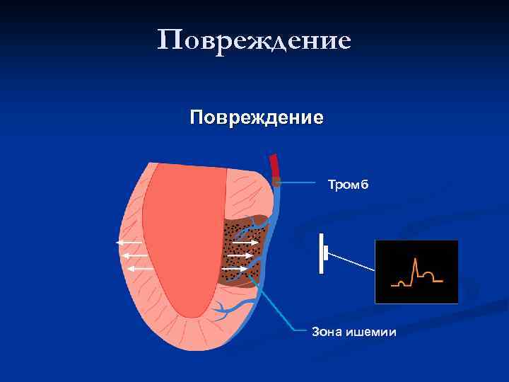 Повреждение Тромб Зона ишемии 