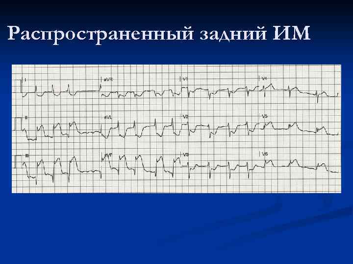 Реполяризационные изменения нижней стенки