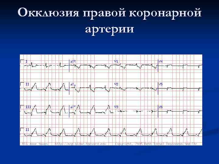 Реполяризационные изменения нижней стенки