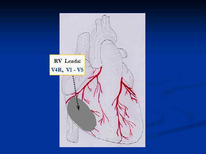 RV Leads: V 4 R, V 1 - V 5 