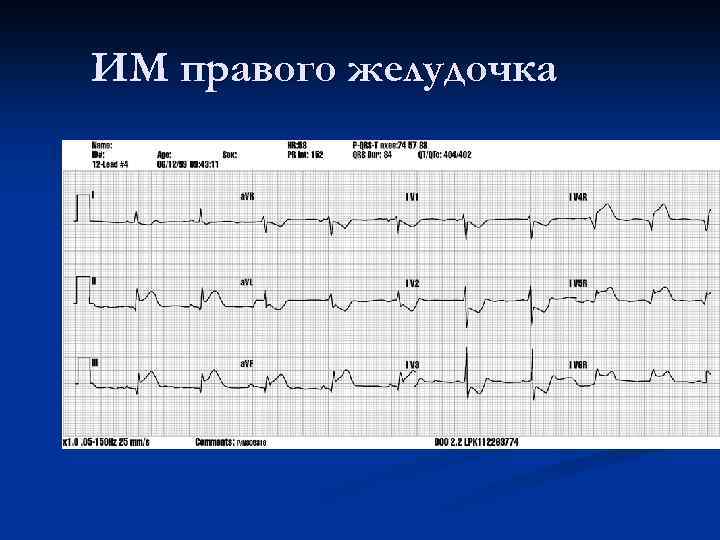 Экг на правую. Инфаркт правого желудочка на ЭКГ. Инфаркт миокарда правого желудочка на ЭКГ. ЭКГ критерии инфаркта миокарда правого желудочка. ЭКГ при инфаркте миокарда правого желудочка.