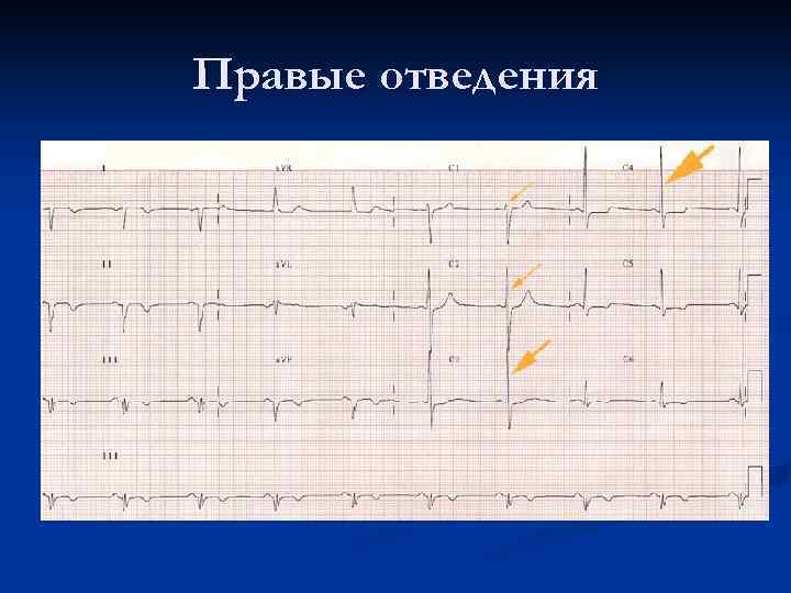 Правые отведения 