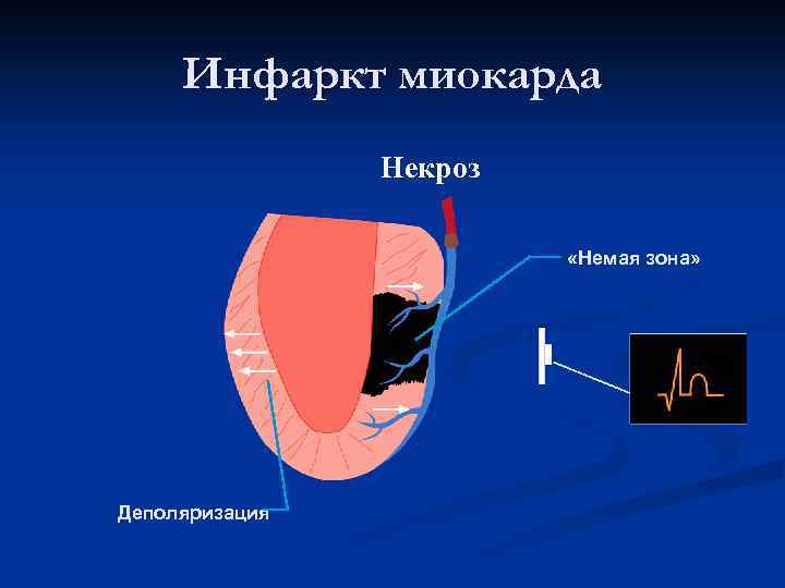 Изменение миокарда левого. Факторы некроза миокарда. Зоны некроза в миокарде на ЭКГ. На наличие зоны некроза в миокарде указывает. Немая зона на ЭКГ.