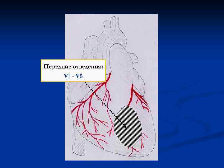 Передние отведения: V 1 - V 5 