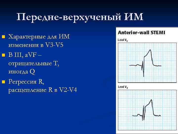 Передне-верхученый ИМ n n n Характерные для ИМ изменения в V 3 -V 5