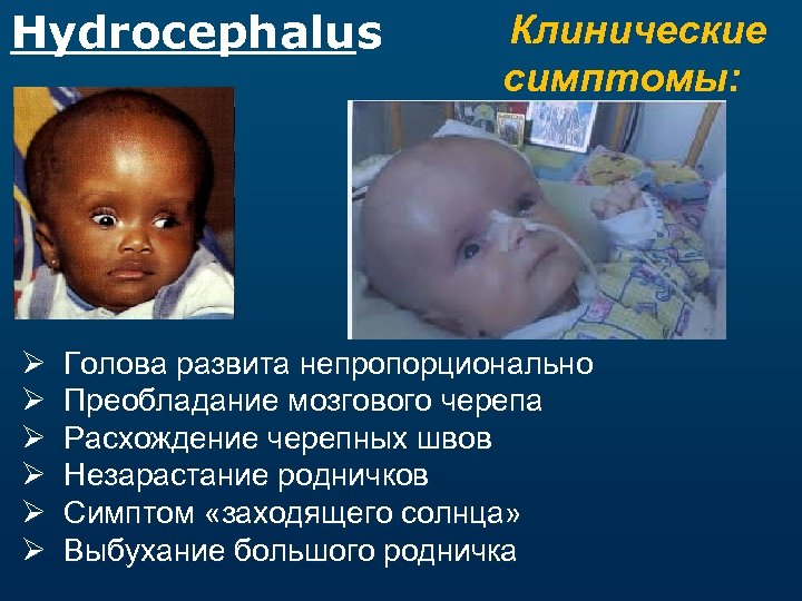 Hydrocephalus Ø Ø Ø Клинические симптомы: Голова развита непропорционально Преобладание мозгового черепа Расхождение черепных