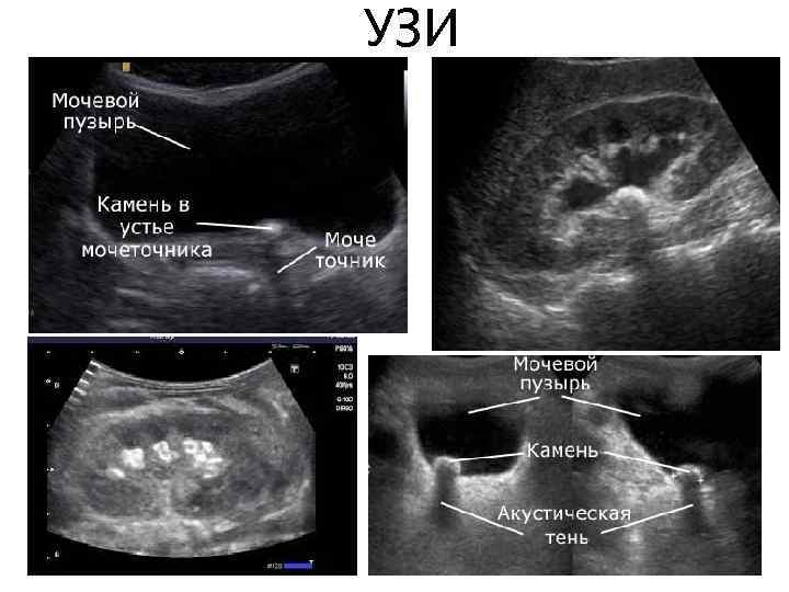 УЗИ 