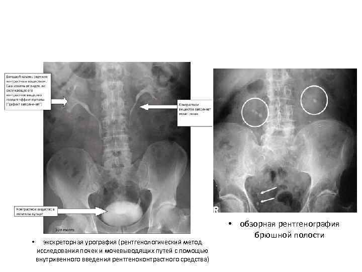  • экскреторная урография (рентгенологический метод исследования почек и мочевыводящих путей с помощью внутривенного