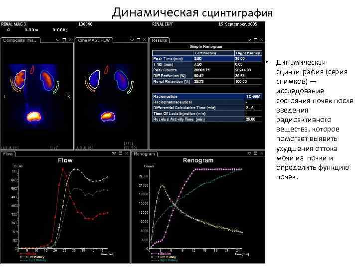 Динамическая сцинтиграфия • Динамическая сцинтиграфия (серия снимков) — исследование состояния почек после введения радиоактивного