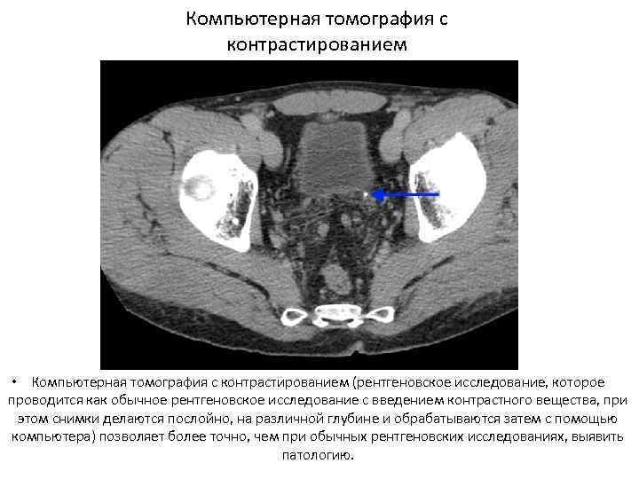 КТ Компьютерная томография с контрастированием • Компьютерная томография с контрастированием (рентгеновское исследование, которое проводится