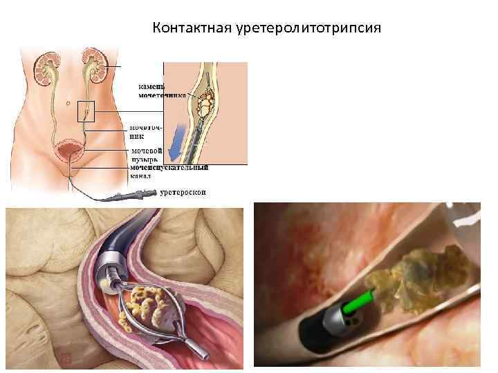 Контактная уретеролитотрипсия 