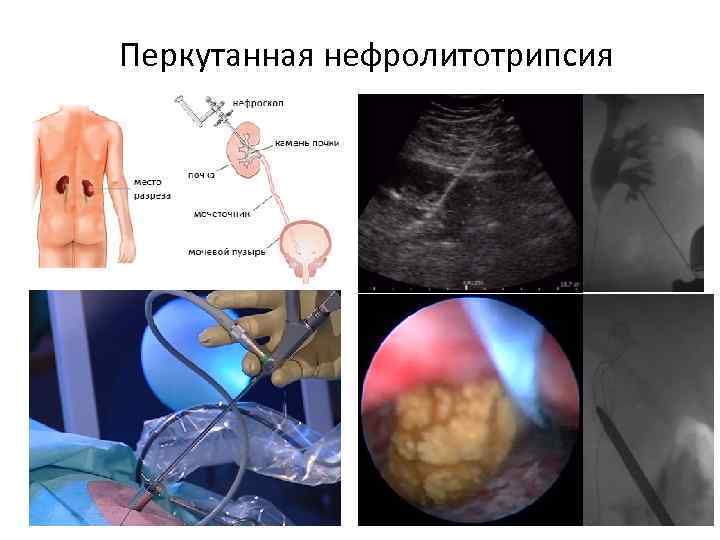 Перкутанная нефролитотрипсия 