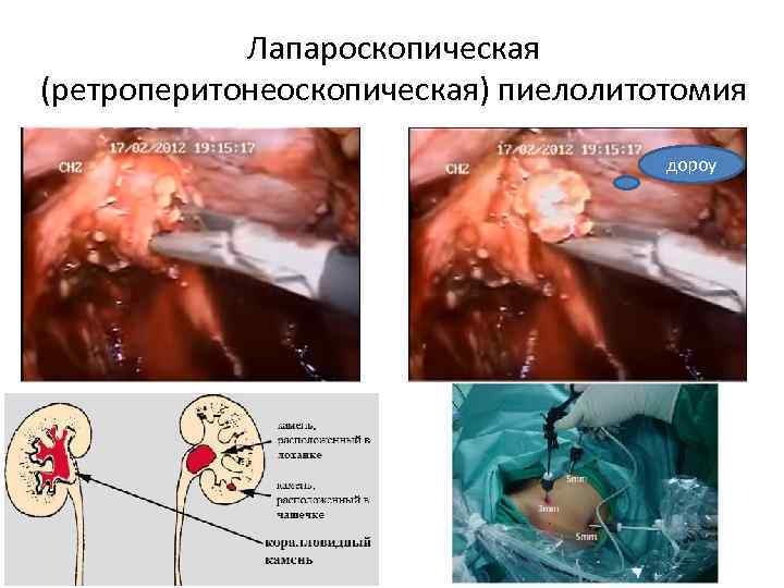 Лапароскопическая (ретроперитонеоскопическая) пиелолитотомия дороу 