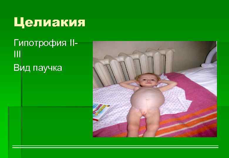 Целиакия Гипотрофия IIIII Вид паучка 