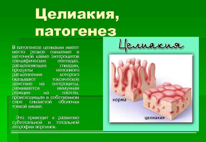 Целиакия, патогенез В патогенезе целиакии имеет место резкое снижение в щеточной кайме энтероцитов специфических