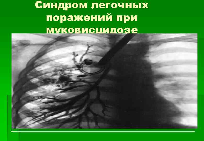 Синдром легочных поражений при муковисцидозе 