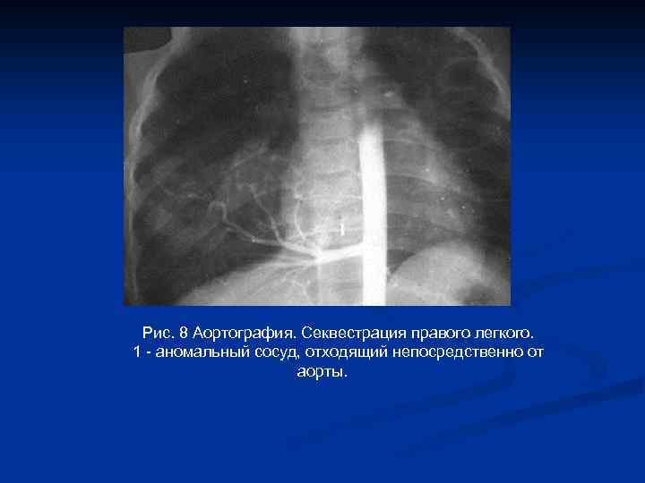 Рис. 8 Аортография. Секвестрация правого легкого. 1 - аномальный сосуд, отходящий непосредственно от аорты.