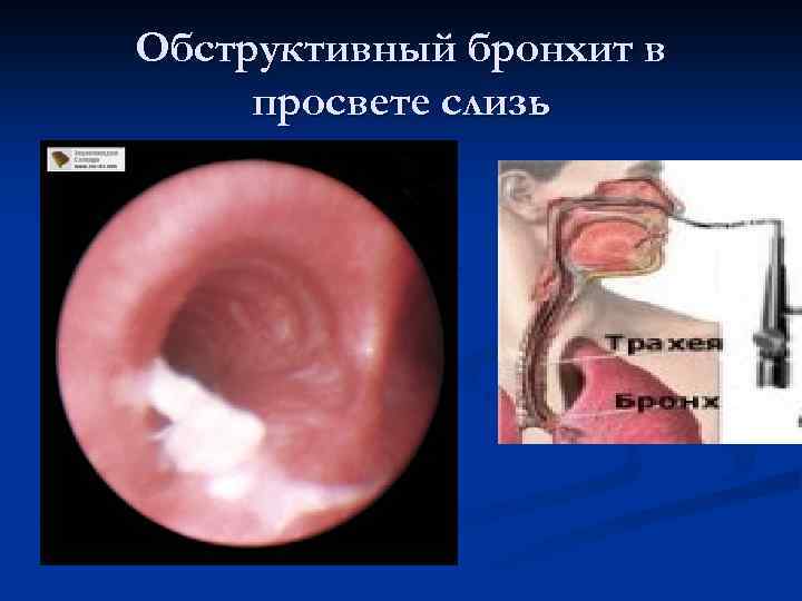 Обструктивный бронхит в просвете слизь 