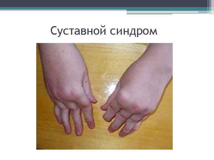 Суставной синдром 