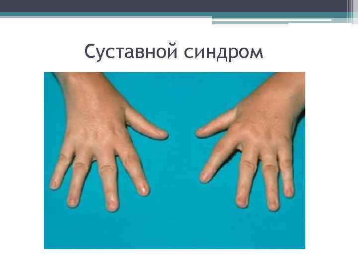 Суставной синдром 