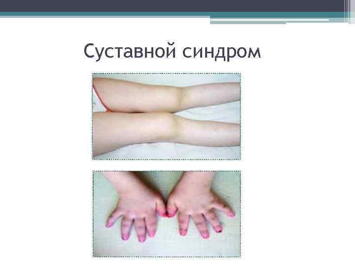 Суставной синдром 