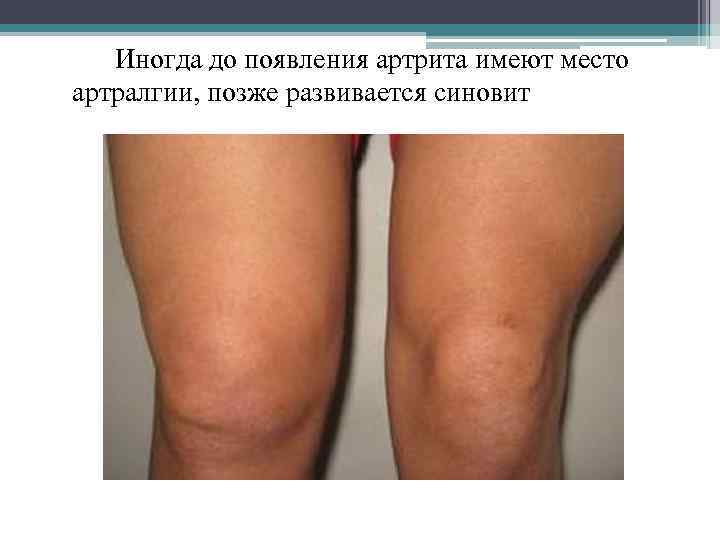  Иногда до появления артрита имеют место артралгии, позже развивается синовит 