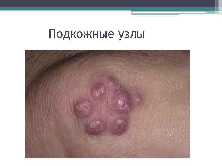 Подкожные узлы 