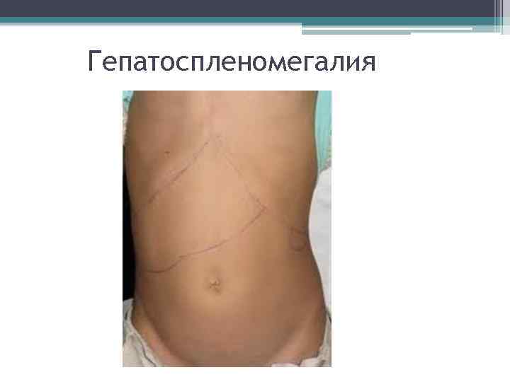 Гепатоспленомегалия 