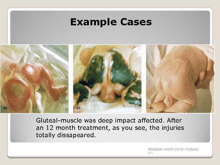 Example Cases Gluteal-muscle was deep impact affected. After an 12 month treatment, as you