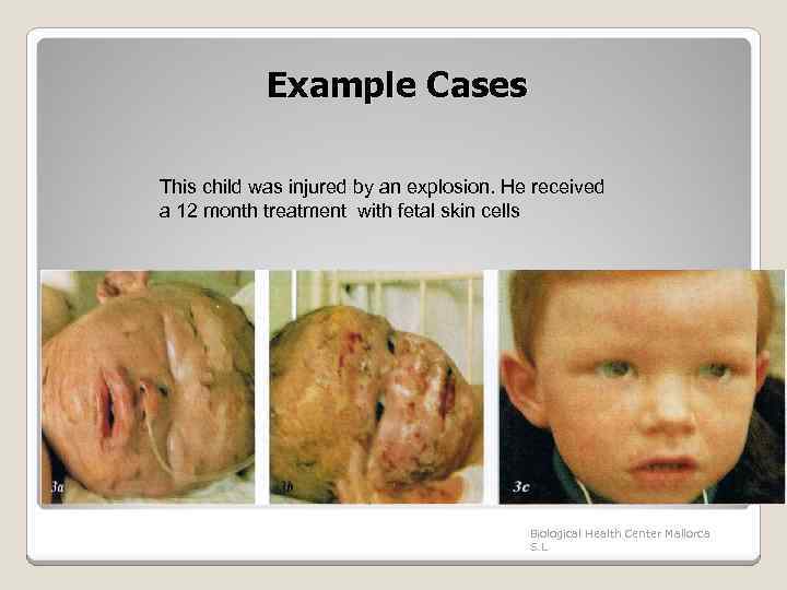 Example Cases This child was injured by an explosion. He received a 12 month