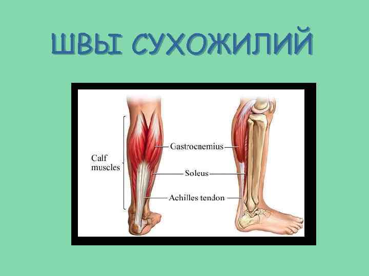 ШВЫ СУХОЖИЛИЙ 