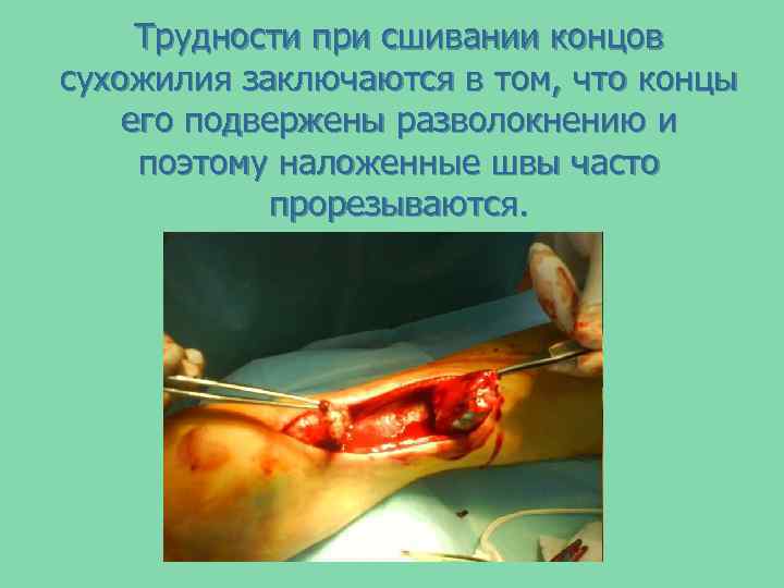 Трудности при сшивании концов сухожилия заключаются в том, что концы его подвержены разволокнению и