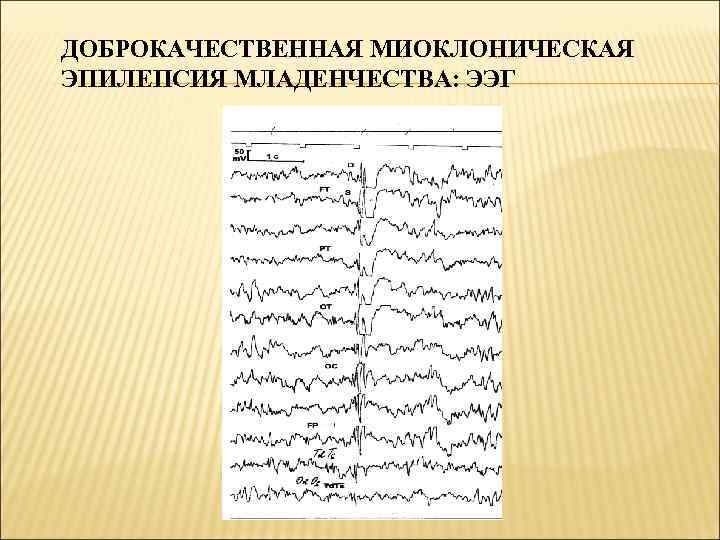 ДОБРОКАЧЕСТВЕННАЯ МИОКЛОНИЧЕСКАЯ ЭПИЛЕПСИЯ МЛАДЕНЧЕСТВА: ЭЭГ 