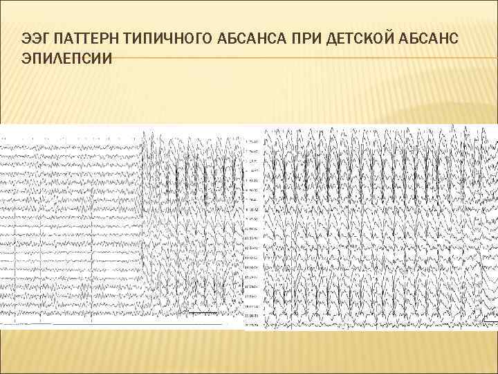 ЭЭГ ПАТТЕРН ТИПИЧНОГО АБСАНСА ПРИ ДЕТСКОЙ АБСАНС ЭПИЛЕПСИИ 