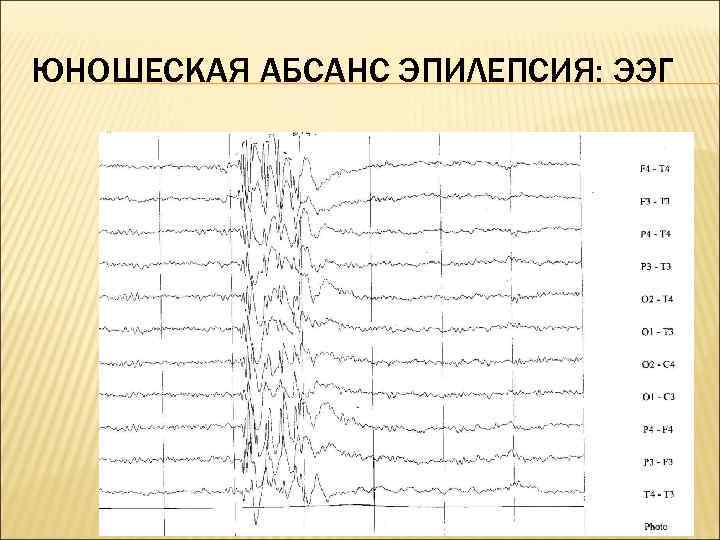 Детская абсансная эпилепсия. Юношеская абсанс эпилепсия ЭЭГ. Спайк волновая активность на ЭЭГ.