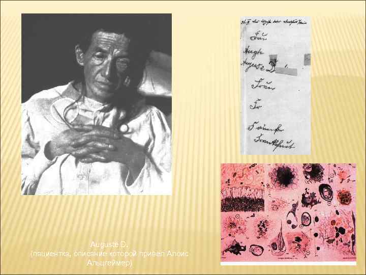 Auguste D. (пациентка, описание которой привел Алоис Альцгеймер) 