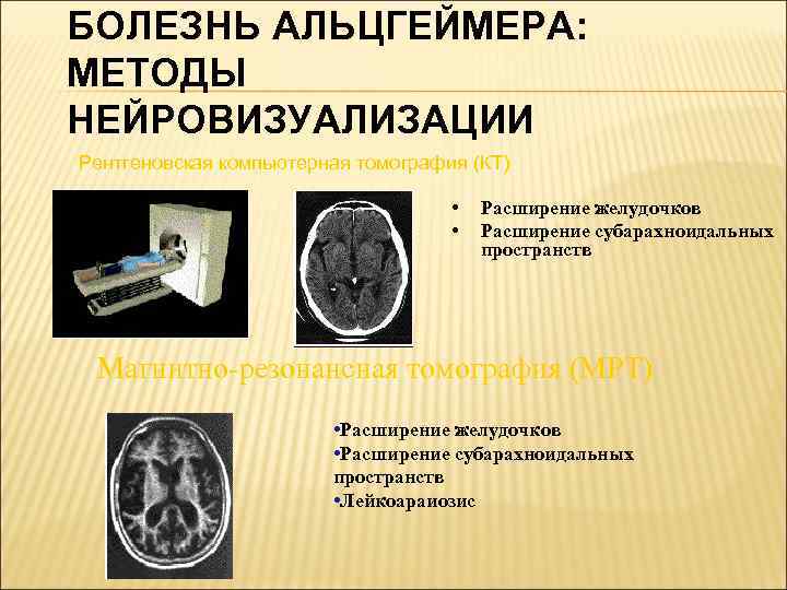БОЛЕЗНЬ АЛЬЦГЕЙМЕРА: МЕТОДЫ НЕЙРОВИЗУАЛИЗАЦИИ Рентгеновская компьютерная томография (КТ) • • Расширение желудочков Расширение субарахноидальных