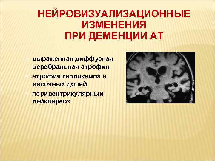 НЕЙРОВИЗУАЛИЗАЦИОННЫЕ ИЗМЕНЕНИЯ ПРИ ДЕМЕНЦИИ АТ • выраженная диффузная церебральная атрофия • атрофия гиппокампа и