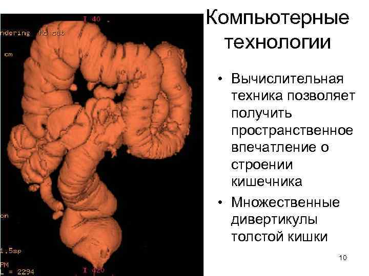 Компьютерные технологии • Вычислительная техника позволяет получить пространственное впечатление о строении кишечника • Множественные