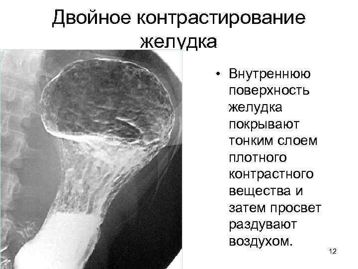 Двойное контрастирование желудка • Внутреннюю поверхность желудка покрывают тонким слоем плотного контрастного вещества и