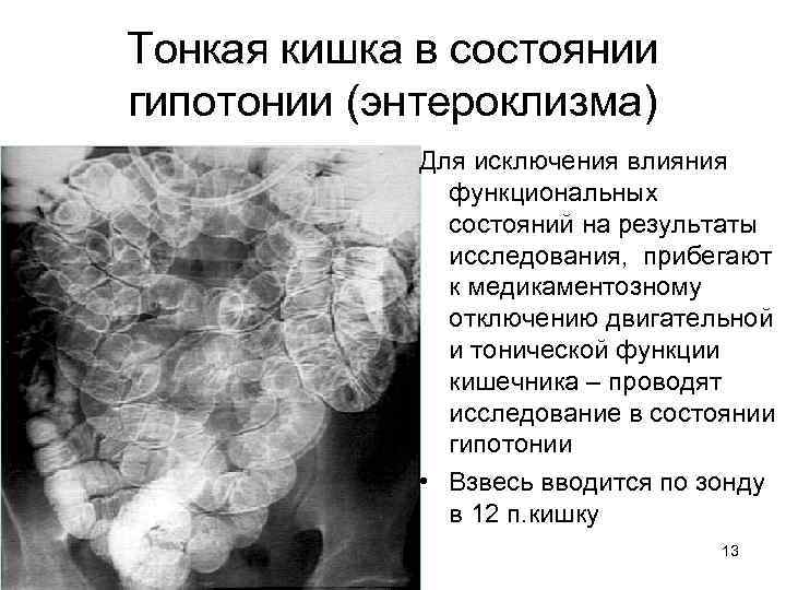 Тонкая кишка в состоянии гипотонии (энтероклизма) Для исключения влияния функциональных состояний на результаты исследования,