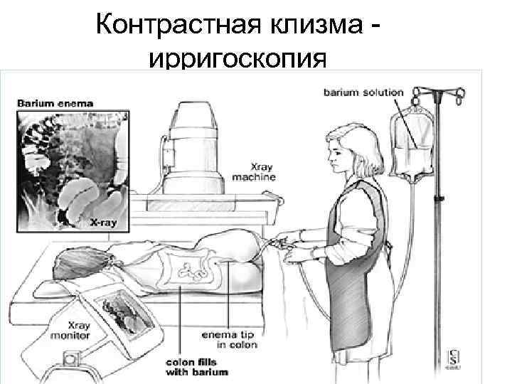 Контрастная клизма ирригоскопия 14 